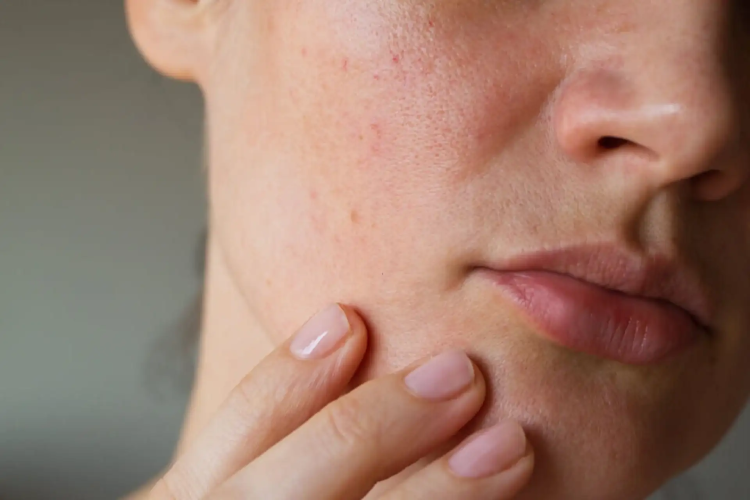 Why You're Breaking Out Even With a Good Skincare Routine - The Real Reasons
